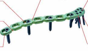 Дистальна ключична пластина, ліва ( Double Medical Technology Inc.)